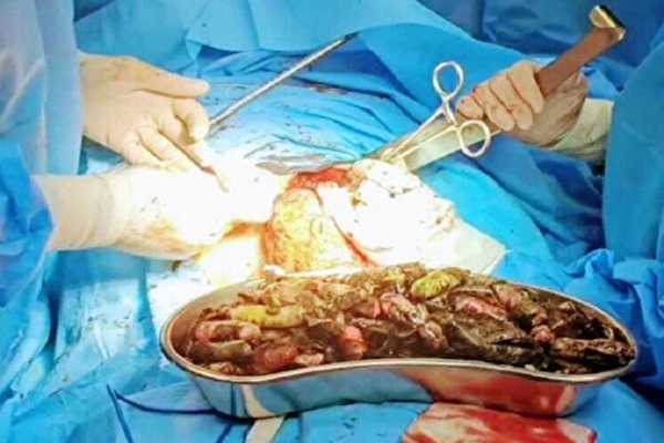 خروج ۹۰ بسته مواد مخدر از معده و روده بیماری در کرج