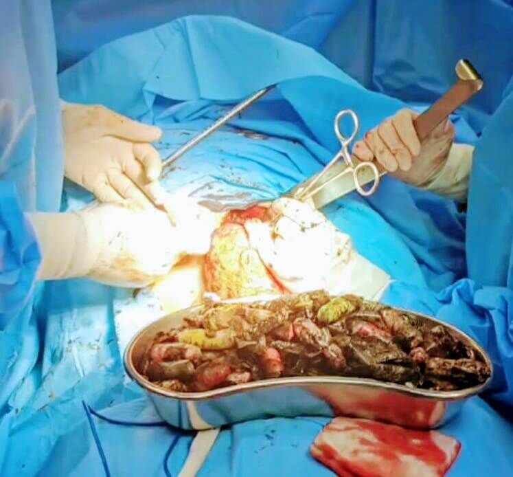 خارج کردن ۹۰ بسته مواد مخدر از معده یک فرد در کرج